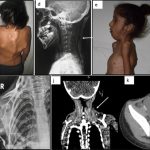 Fibrodysplasia ossificans progressiva