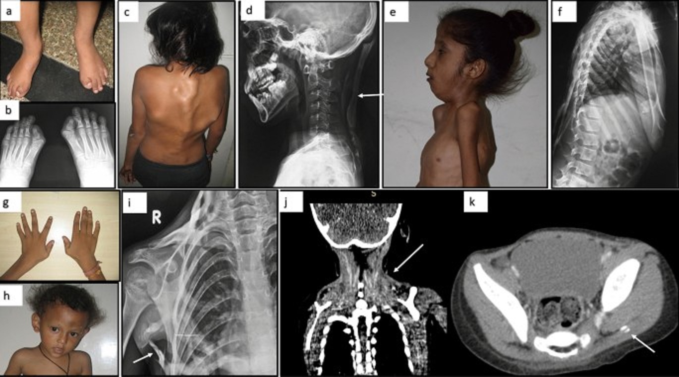 Fibrodysplasia Ossificans Progressiva - Helping Fibrodysplasia ...